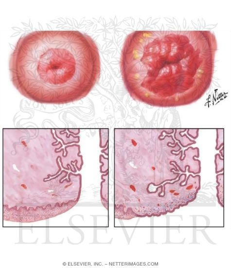 Cervical Erosion