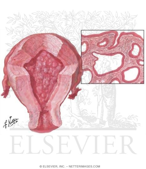 Endometrial Hyperplasia: Simple and Complex