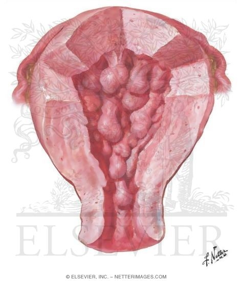 Endometrial Polyps