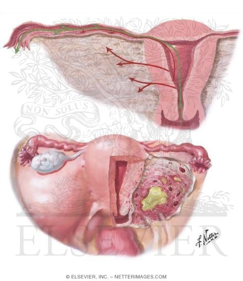 Endometritis