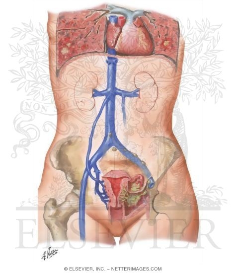 Endometritis
Puerperal Infection