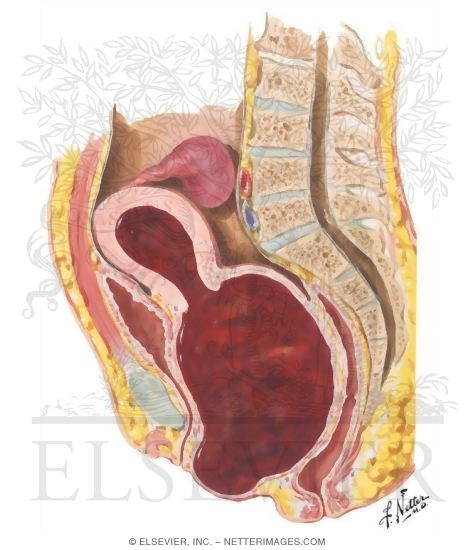 Hematometra