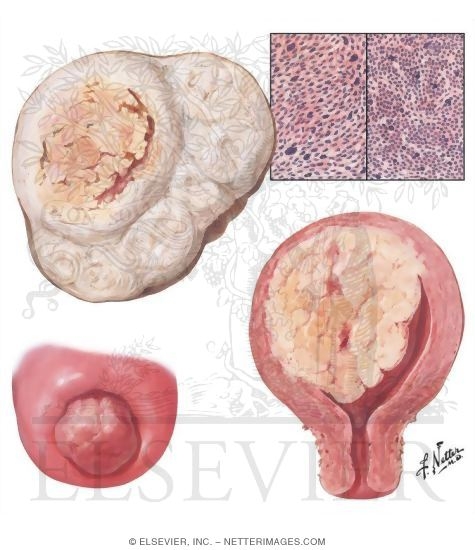 Uterine Sarcoma