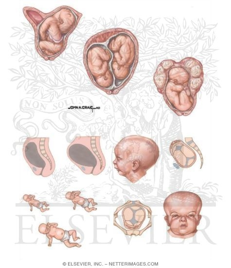 Watermarked preview of unlabeled image: Breech Birth