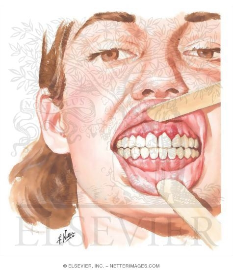 Gingivitis In Pregnancy