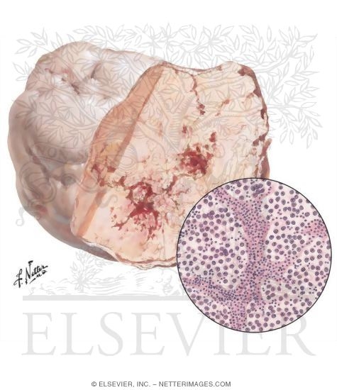 Watermarked preview of unlabeled image: Dysgerminoma