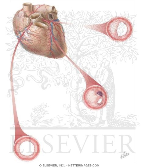 Coronary Vessels: Sternocostal Surface