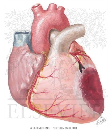 Myocardial Infarction