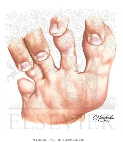 Watermarked preview of unlabeled image: Changes In Skin Color In the Diabetic Foot