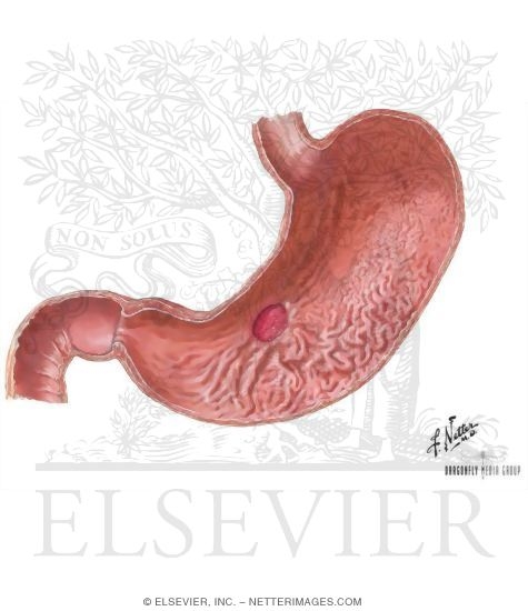 Watermarked preview of unlabeled image: Peptic Ulcer Disease
