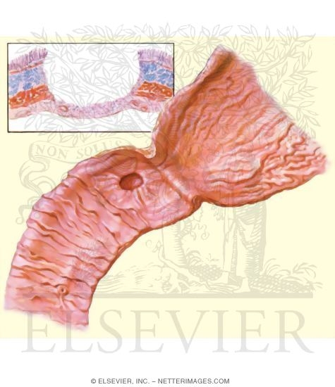 Watermarked preview of unlabeled image: Duodenal Ulcer