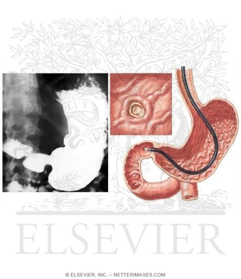 Watermarked preview of unlabeled image: Diagnosing Peptic Ulcers