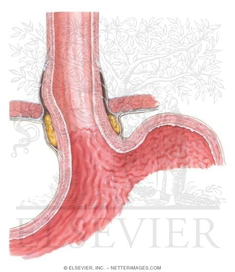 Watermarked preview of unlabeled image: Esophagus