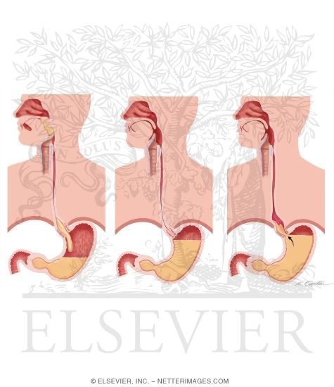 Watermarked preview of unlabeled image: Description of Gastroesophageal Reflux Disease (GERD)