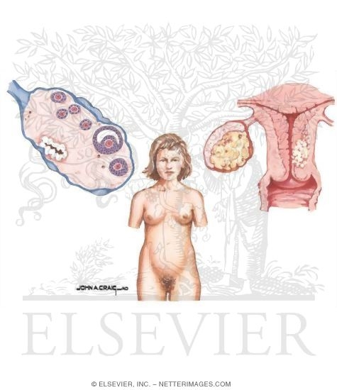Stromal (Sex Cord) Ovarian Tumor