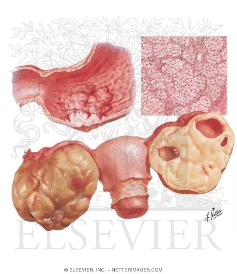 Krukenberg Tumor