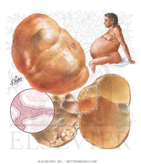 Mucinous Ovarian Cysts