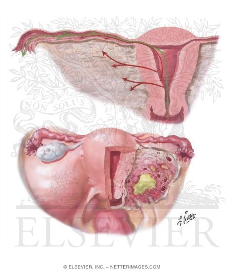 Pelvic Inflammatory Disease (PID)