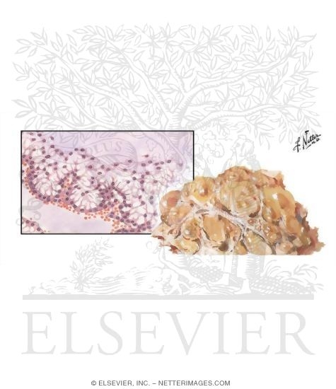 Pseudomyxoma Peitonei