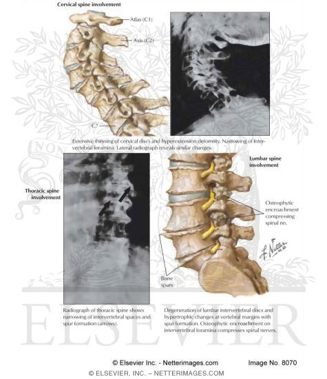 Spine Involvement In Osteoarthritis
