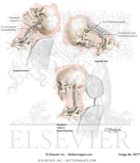 Watermarked preview of labeled image: Whiplash