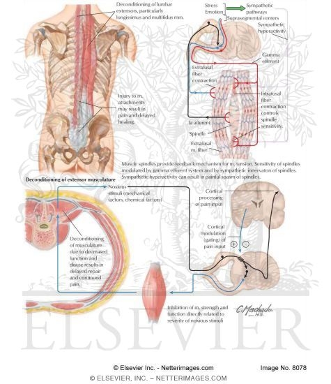 Myofascial Causes of Back Pain