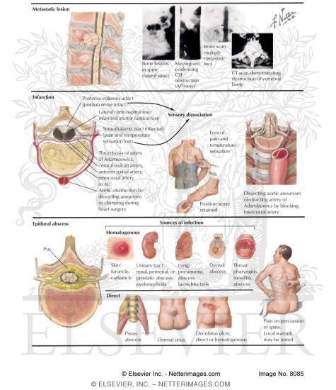Watermarked preview of labeled image: Acute Spinal Cord Syndromes