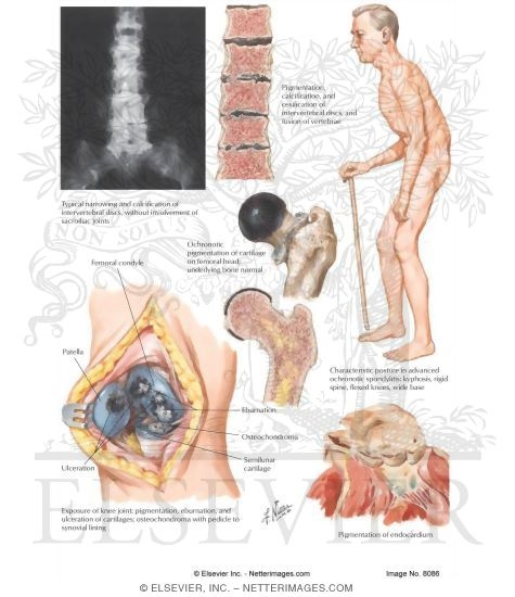 Ochronosis