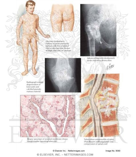 Watermarked preview of labeled image: Tuberculous Arthritis