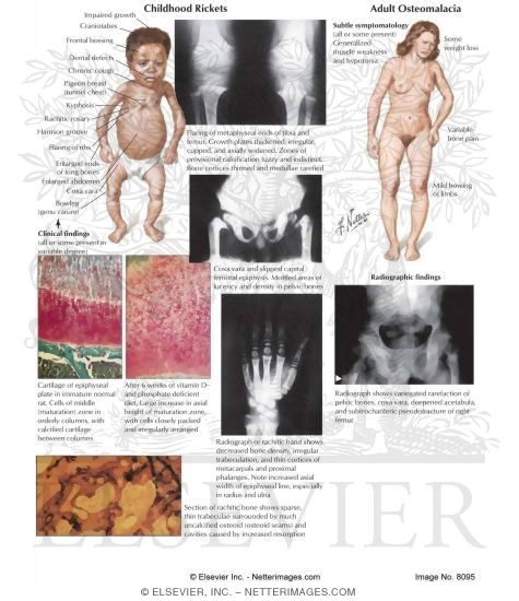 Childhood Rickets, Adult Osteomalacia
