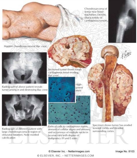Chondrosarcoma