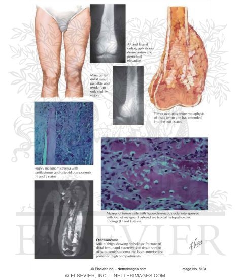Watermarked preview of labeled image: Osteosarcoma