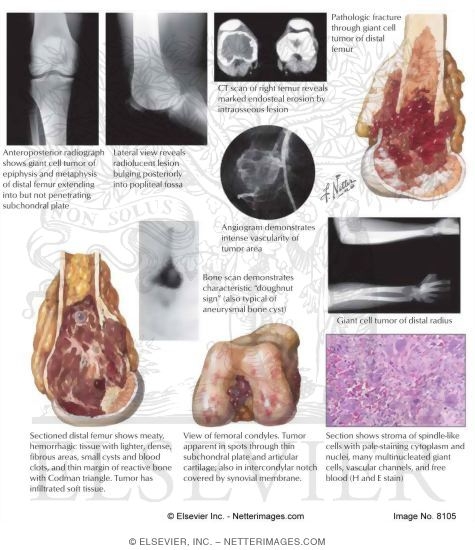 Watermarked preview of labeled image: Giant-Cell Tumor of Bone