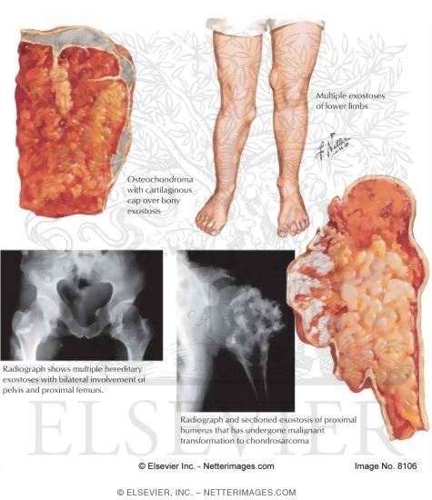 Osteocartilaginous Exostosis (Osteochondroma)