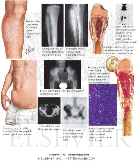 Ewing's Sarcoma