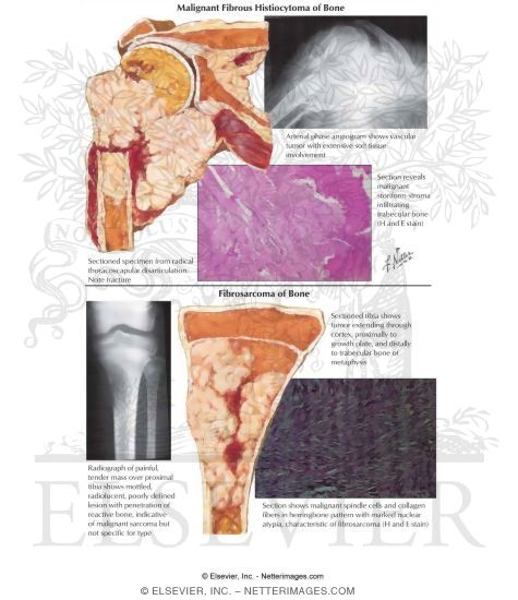 Watermarked preview of labeled image: Malignant Fibrous Histiocytoma of Bone, Fibrosarcoma of Bone