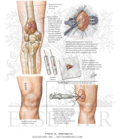 Watermarked preview of labeled image: Tumor Biopsy