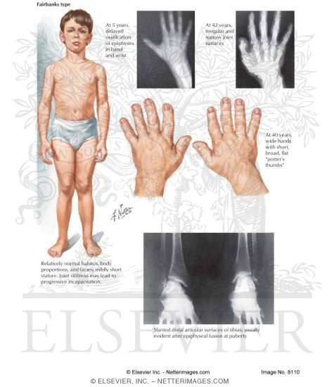 Multiple Epiphyseal Dysplasia
