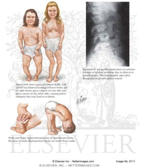 Pseudoachondroplasia