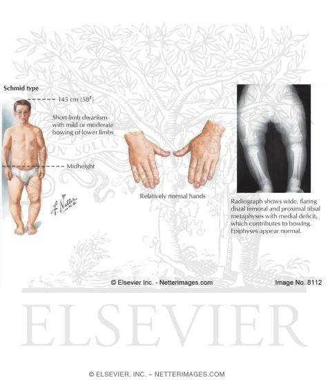 Metaphyseal Chondrodysplasias