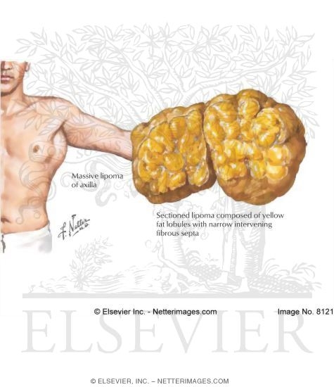 Soft Tissue Tumor of the Axilla