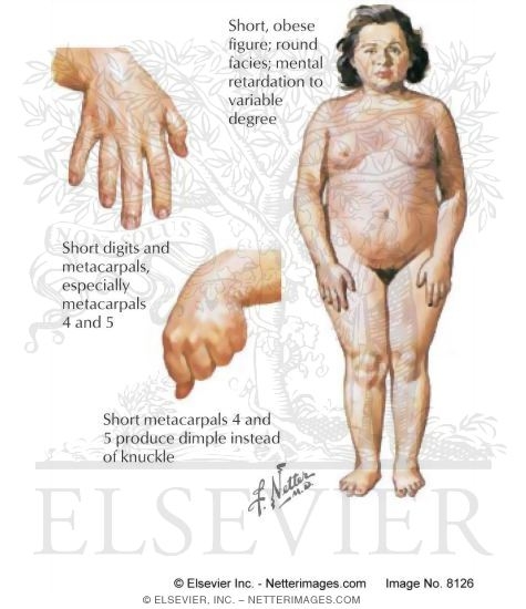 Albright's Hereditary Osteodystrophy