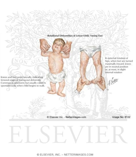 Watermarked preview of labeled image: External Rotation of Hips
Rotational Deformities of Lower Limb: Toeing-Out