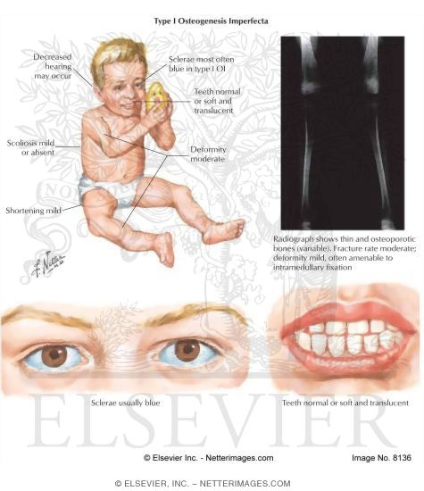 Type I Osteogenesis Imperfecta