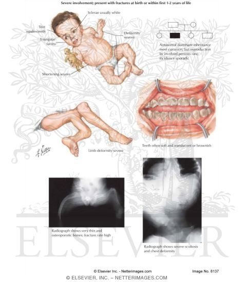 osteogenesis imperfecta type 3