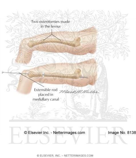 Treatment Of Osteogenesis Imperfecta By Intramedullary Fixation