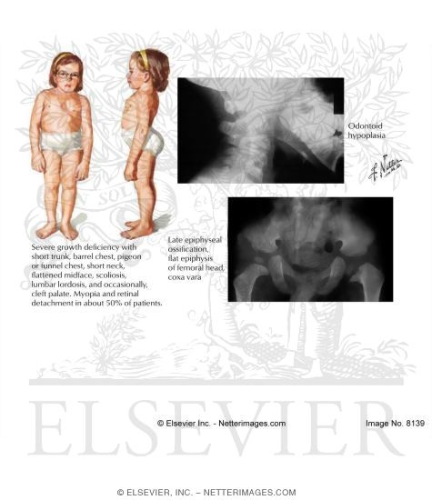 Spondyloepiphyseal Dysplasia Congenita