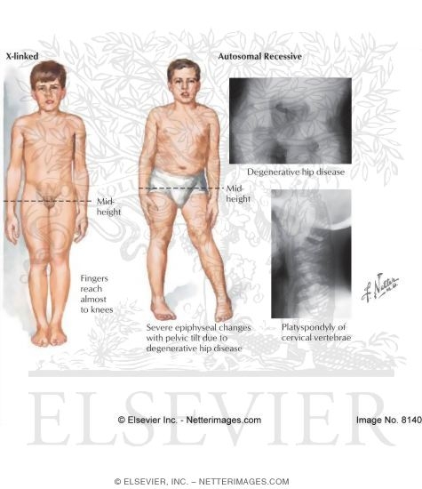 Spondyloepiphyseal Dysplasia Tarda