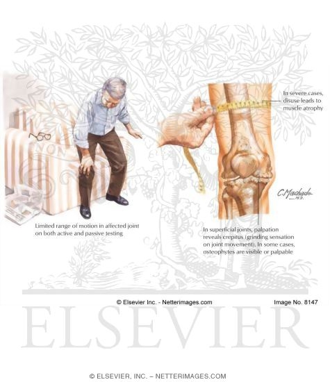 Clinical Findings In Osteoarthritis (OA)