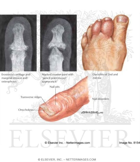 Watermarked preview of labeled image: Psoriatic Arthritis